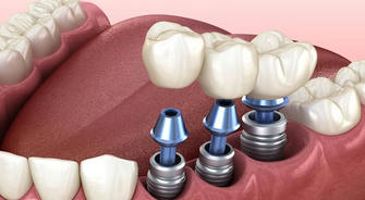 Dental Implants: Guardians of a Healthy Mouth