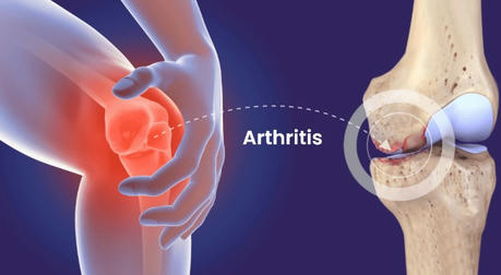 Arthritis: Understanding the Condition and Its Management