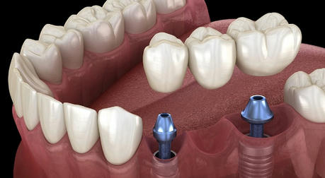 The relationship between dental implants and oral health