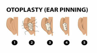 Otoplasty in Mexico: A Combination of Art and Science