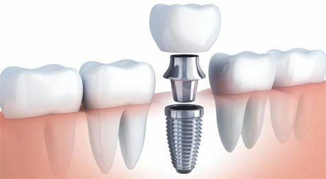 Dental Implants: A Modern Option to Restore the Joy of Chewing